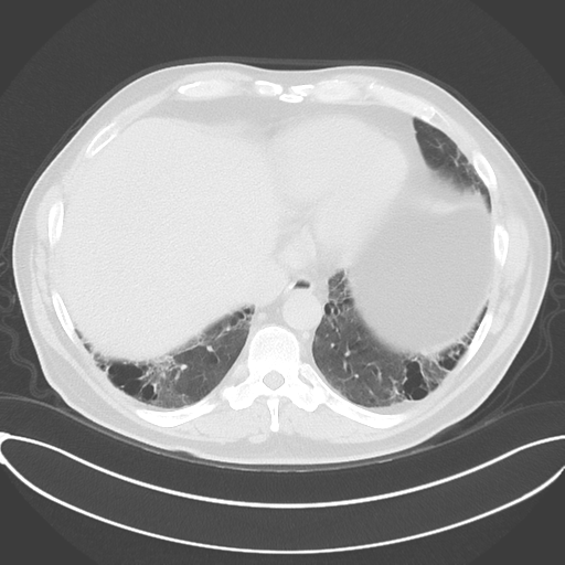 Chronic hypersensitivity pneumonitis (Radiopaedia 48107-52922 Axial lung window 47).png