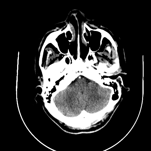 Chronic invasive fungal sinusitis (Radiopaedia 91563-109286 B 14).jpg