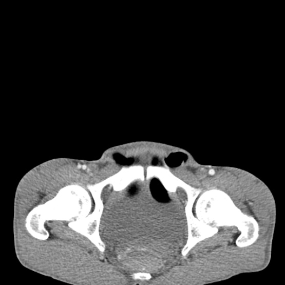 Chronic large bowel pseudo-obstruction (Radiopaedia 43181-46492 A 158).jpg
