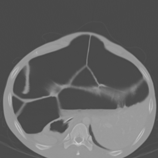 Chronic large bowel pseudo-obstruction (Radiopaedia 43181-46492 Axial bone window 49).jpg
