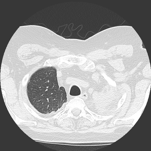Chronic lung allograft dysfunction - restrictive form (Radiopaedia 60595-68316 Axial lung window 11).jpg