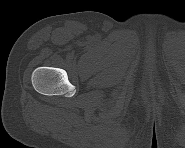 Chronic ostemyelitis of the femur with long sinus tract (Radiopaedia 74947-85982 Axial bone window 21).jpg