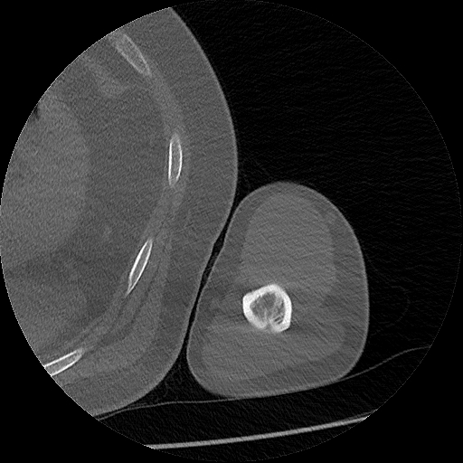 Chronic osteomyelitis (Radiopaedia 67597-76998 Axial bone window 42).jpg