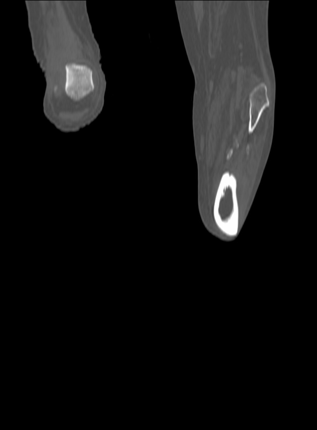 Chronic osteomyelitis - tibia (with sequestrum) (Radiopaedia 73273-84090 Coronal non-contrast 77).jpg