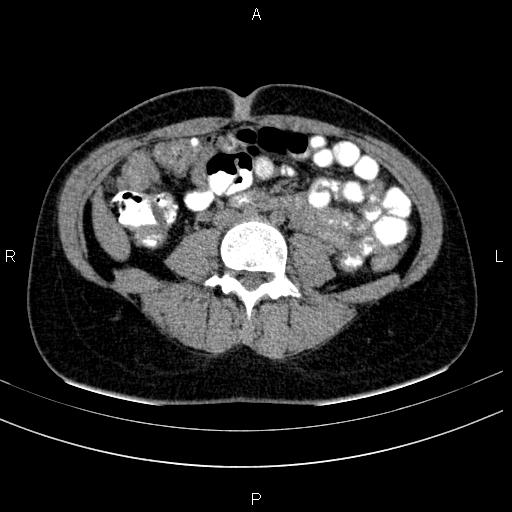 Chronic pancreatitis (Radiopaedia 64576-73450 Axial non-contrast 95).jpg