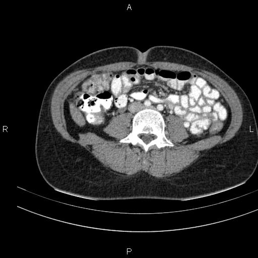 Chronic pancreatitis (Radiopaedia 64576-73450 B 98).jpg