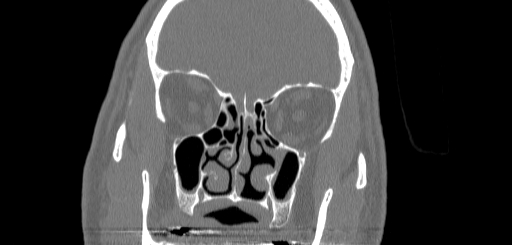 Chronic sphenoidal sinusitis (Radiopaedia 62030-70122 Coronal bone window 66).jpg