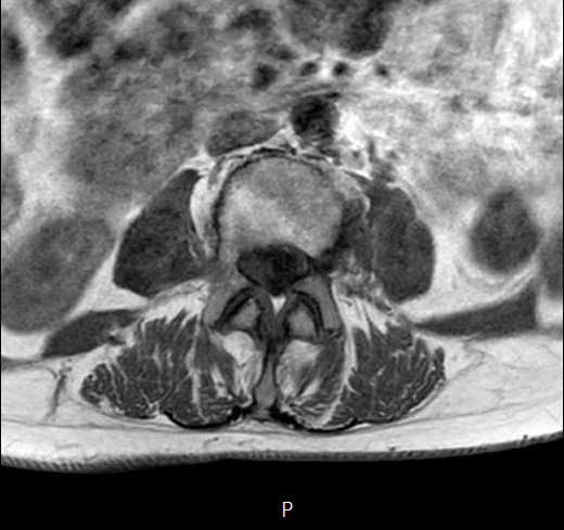File:Chronic spinal hematoma with cauda equina syndrome (Radiopaedia 75745-87090 Axial T1 15).png