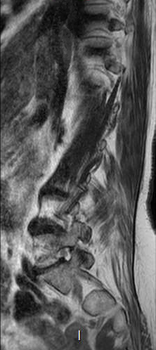 File:Chronic spinal hematoma with cauda equina syndrome (Radiopaedia 75745-87090 Sagittal T2 12).png
