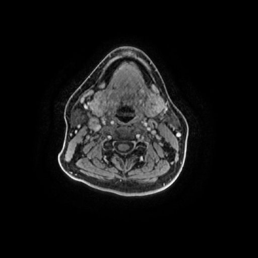 Chronic submandibular sialadenitis (Radiopaedia 61852-69885 Axial T1 C+ fat sat 53).jpg