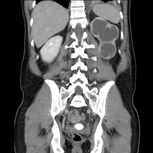 File:Chronic ureteropelvic junction obstruction (Radiopaedia 78365-90996 B 75).jpg