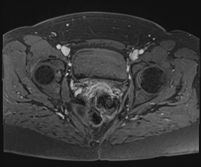 File:Class II Mullerian duct anomaly- unicornuate uterus with rudimentary horn and non-communicating cavity (Radiopaedia 39441-41755 Axial T1 fat sat 95).jpg