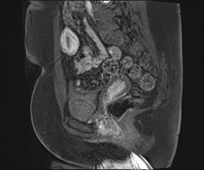File:Class II Mullerian duct anomaly- unicornuate uterus with rudimentary horn and non-communicating cavity (Radiopaedia 39441-41755 G 46).jpg