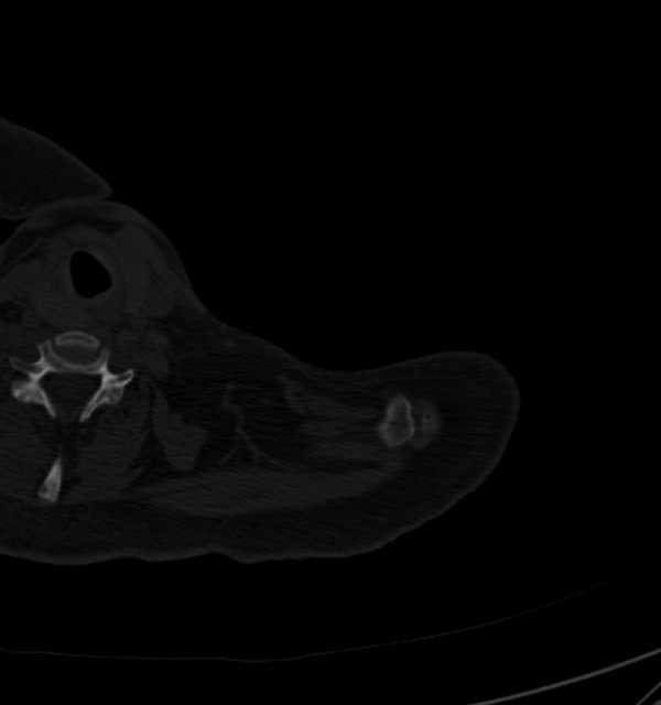 Clear cell chondrosarcoma - humerus (Radiopaedia 63104-71612 Axial bone window 5).jpg