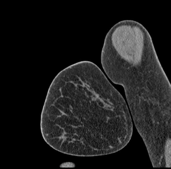 Clear cell chondrosarcoma - humerus (Radiopaedia 63104-71612 D 6).jpg