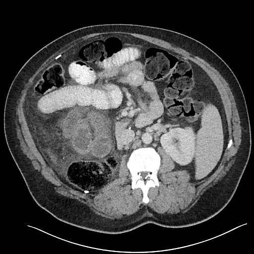 File:Closed loop obstruction - internal hernia into nephrectomy bed (Radiopaedia 59867-67320 Axial 29).jpg