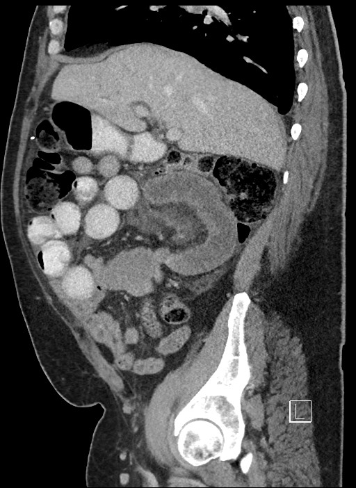 Closed loop obstruction - internal hernia into nephrectomy bed (Radiopaedia 59867-67320 C 70).jpg