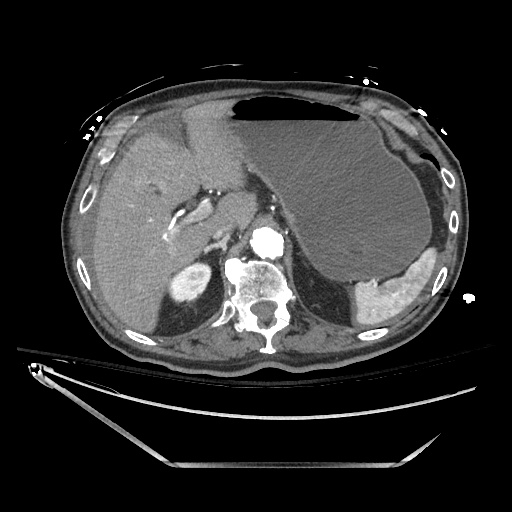 File:Closed loop obstruction due to adhesive band, resulting in small bowel ischemia and resection (Radiopaedia 83835-99023 B 39).jpg