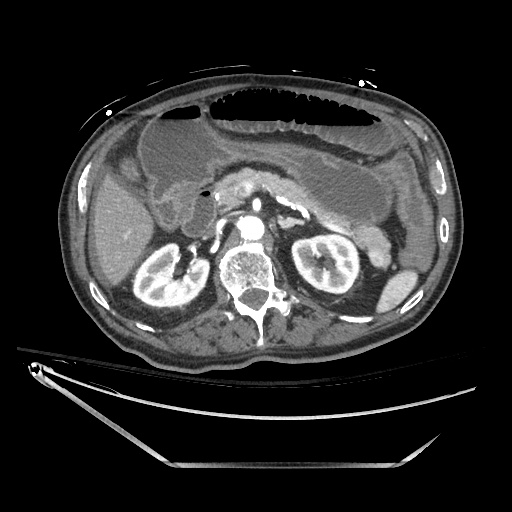 File:Closed loop obstruction due to adhesive band, resulting in small bowel ischemia and resection (Radiopaedia 83835-99023 B 54).jpg