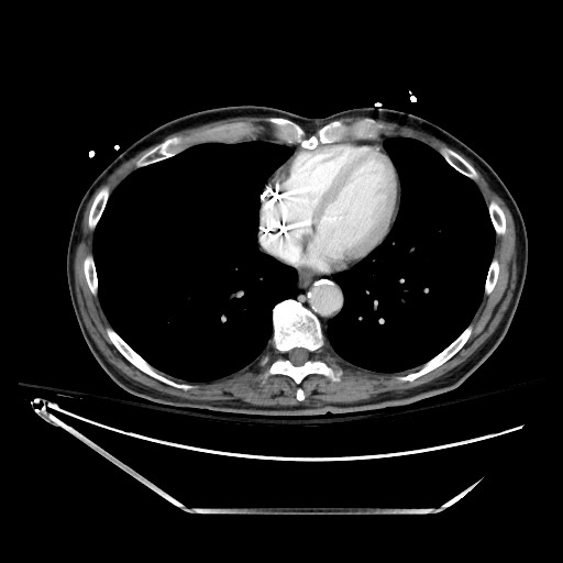 File:Closed loop obstruction due to adhesive band, resulting in small bowel ischemia and resection (Radiopaedia 83835-99023 D 12).jpg