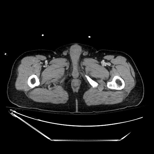 File:Closed loop obstruction due to adhesive band, resulting in small bowel ischemia and resection (Radiopaedia 83835-99023 D 174).jpg