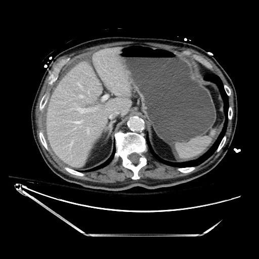 File:Closed loop obstruction due to adhesive band, resulting in small bowel ischemia and resection (Radiopaedia 83835-99023 D 38).jpg