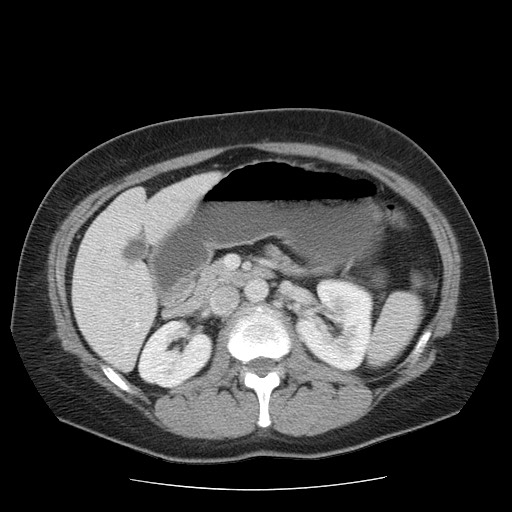 File:Closed loop small bowel obstruction (Radiopaedia 65403-74451 Axial 35).jpg