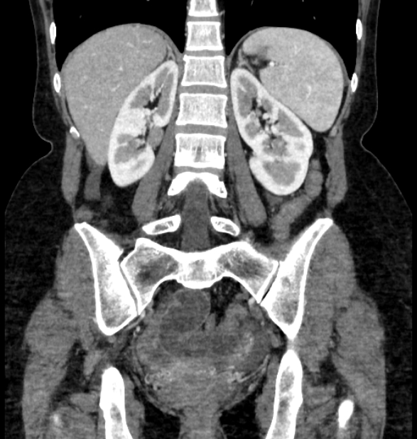 Closed loop small bowel obstruction (Radiopaedia 71211-81508 B 87).jpg