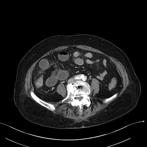 Closed loop small bowel obstruction - adhesions (Radiopaedia 59269-66611 A 81).jpg