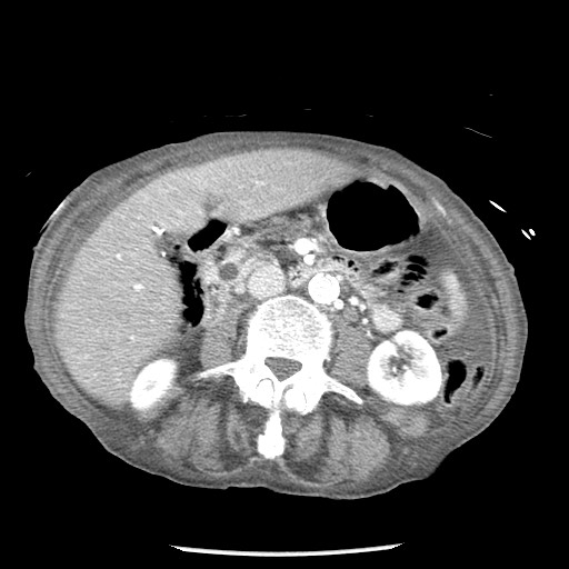 File:Closed loop small bowel obstruction - adhesions and infarct (Radiopaedia 85125-100678 B 44).jpg