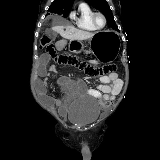 Closed loop small bowel obstruction - adhesive disease and hemorrhagic ischemia (Radiopaedia 86831-102990 B 42).jpg