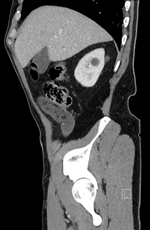 Closed loop small bowel obstruction - internal hernia (Radiopaedia 57806-64778 C 87).jpg