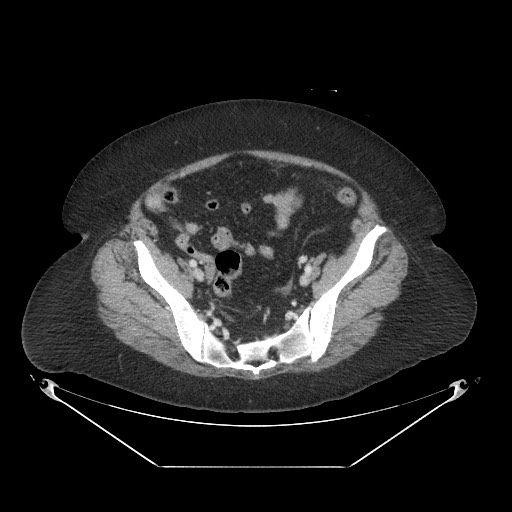 Closed loop small bowel obstruction - internal hernia (Radiopaedia 65402-74450 A 104).jpg