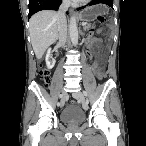 Closed loop small bowel obstruction - omental adhesion causing "internal hernia" (Radiopaedia 85129-100682 B 72).jpg