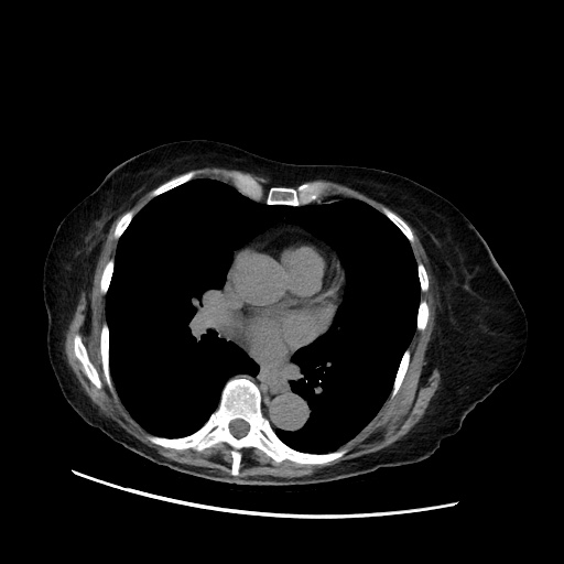 File:Closed loop small bowel obstruction due to adhesive band, with intramural hemorrhage and ischemia (Radiopaedia 83831-99017 Axial non-contrast 1).jpg