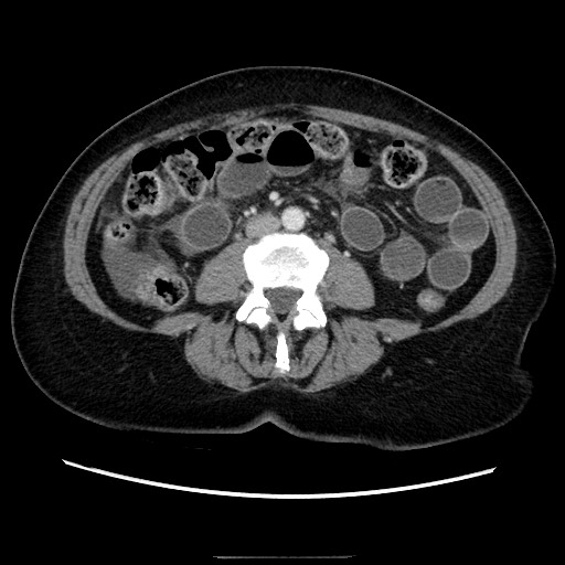 Closed loop small bowel obstruction due to adhesive bands - early and late images (Radiopaedia 83830-99015 A 89).jpg