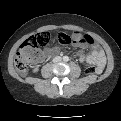 File:Closed loop small bowel obstruction due to trans-omental herniation (Radiopaedia 35593-37109 A 48).jpg