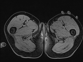 Closed loop small bowel obstruction in pregnancy (MRI) (Radiopaedia 87637-104031 G 46).jpg