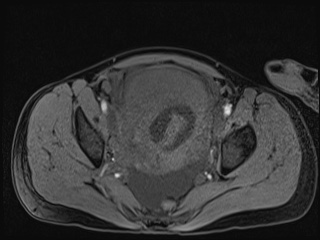 Closed loop small bowel obstruction in pregnancy (MRI) (Radiopaedia 87637-104031 G 7).jpg