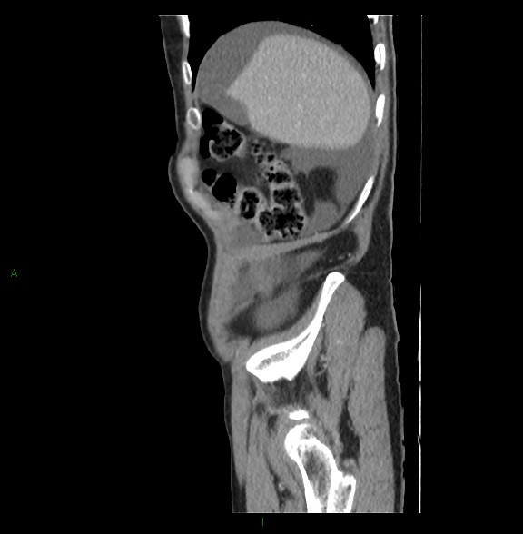 Closed loop small bowel obstruction with ischemia (Radiopaedia 84180-99456 C 16).jpg