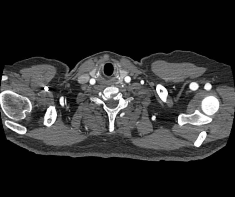 Coarctation of the aorta (Radiopaedia 53752-59822 A 9).jpg