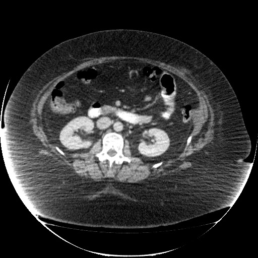File:Collection due to leak after sleeve gastrectomy (Radiopaedia 55504-61972 A 38).jpg