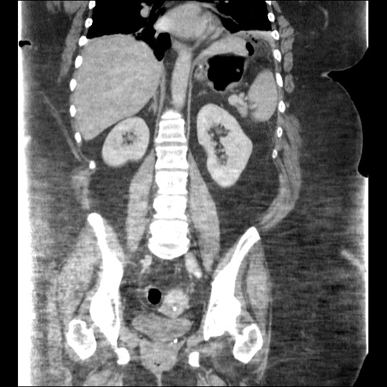 File:Collection due to leak after sleeve gastrectomy (Radiopaedia 55504-61972 B 31).jpg