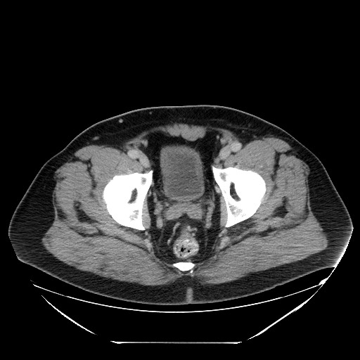 Colocolic intussusception due to lipoma (Radiopaedia 73712-84508 A 108).jpg