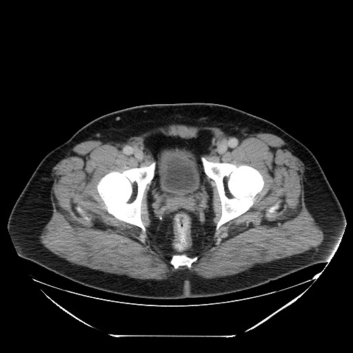 Colocolic intussusception due to lipoma (Radiopaedia 73712-84508 A 110).jpg