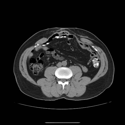 File:Colocutaneous fistula in Crohn's disease (Radiopaedia 29586-30093 D 9).jpg