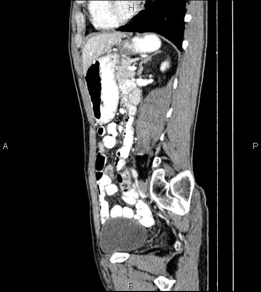 File:Colon adenocarcinoma - hepatic flexure (Radiopaedia 85635-101395 D 57).jpg