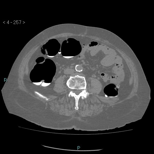 Colonic lipomas (Radiopaedia 49137-54244 Axial bone window 115).jpg