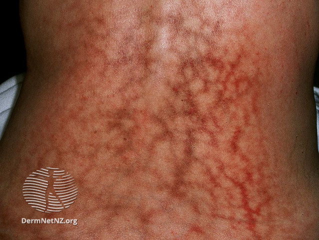File:Erythema ab igne (DermNet NZ vascular-telangiectases-12).jpg