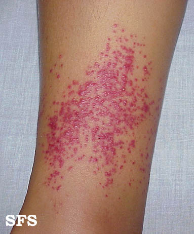 File:Folliculitis (Dermatology Atlas 1).jpg